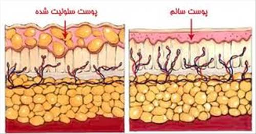 سلولیت چیست و چگونه می توانیم آن را درمان کنیم